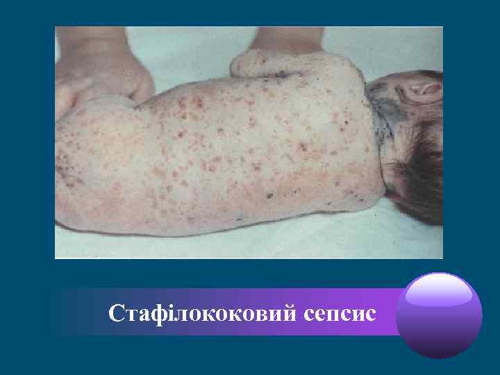 Стафілококовий сепсис 