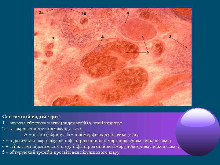 Септичний ендометрит 1 – слизова оболонка матки (ендометрій) в стані некрозу; 2 – в