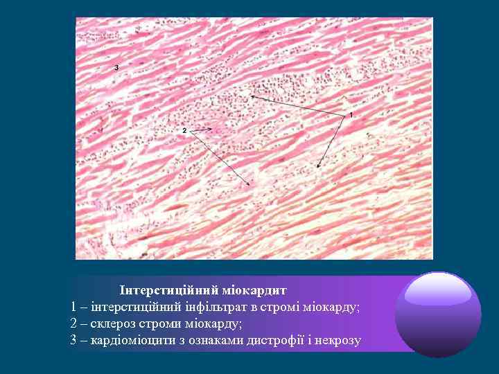 Інтерстиційний міокардит 1 – інтерстиційний інфільтрат в стромі міокарду; 2 – склероз строми міокарду;