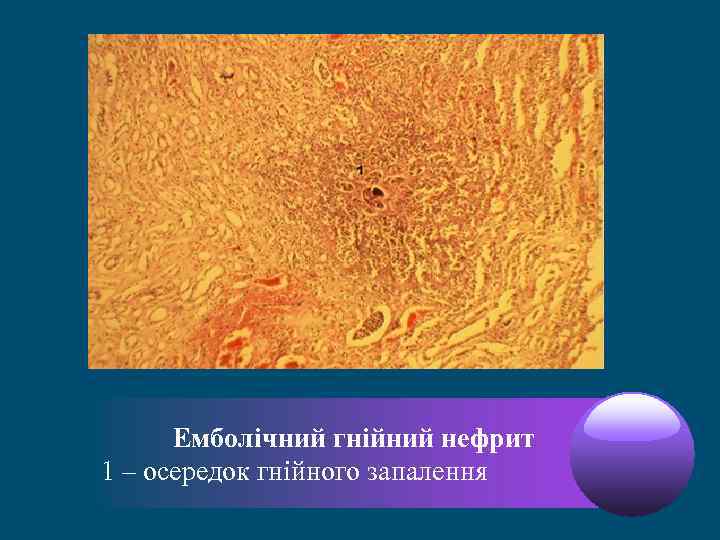 Емболічний гнійний нефрит 1 – осередок гнійного запалення 