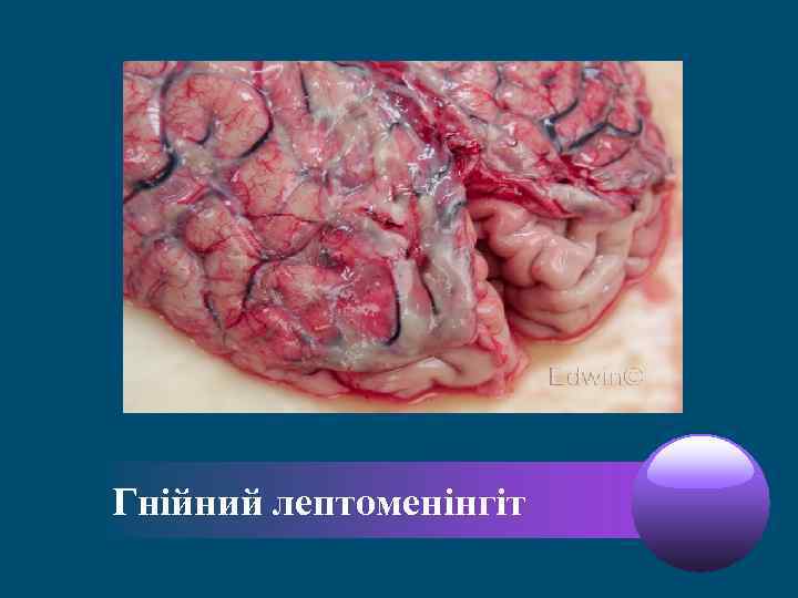 Гнійний лептоменінгіт 