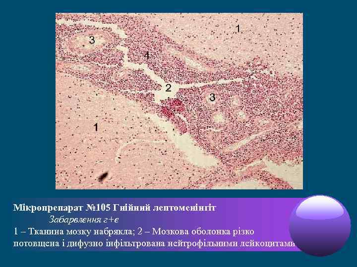 Мікропрепарат № 105 Гнійний лептоменінгіт Забарвлення г+е 1 – Тканина мозку набрякла; 2 –