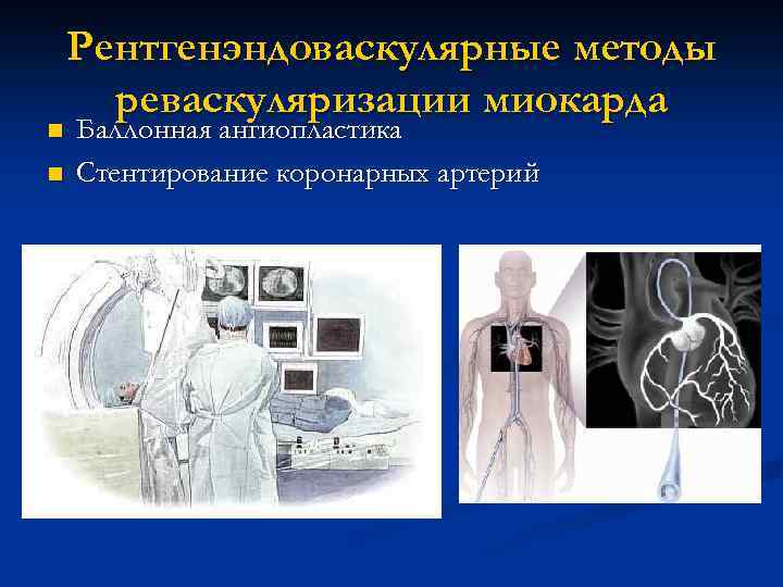 n n Рентгенэндоваскулярные методы реваскуляризации миокарда Баллонная ангиопластика Стентирование коронарных артерий 