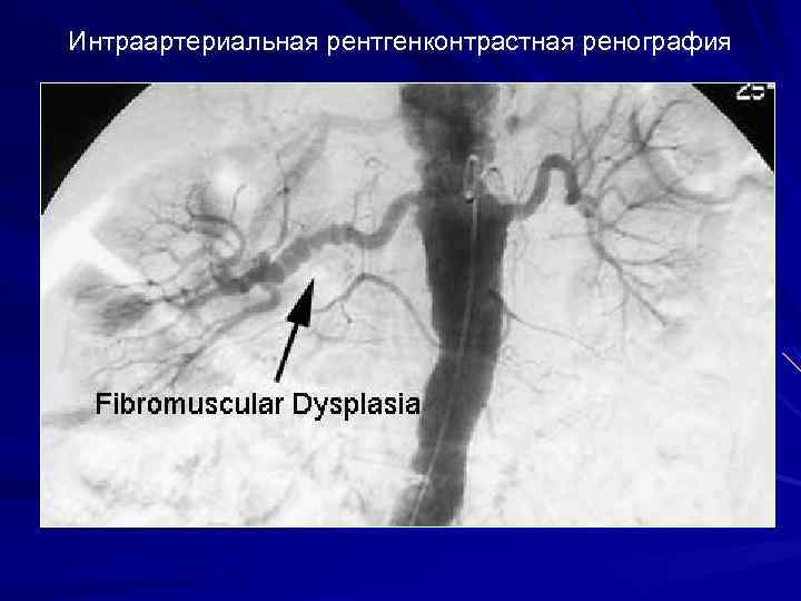Интраартериальная рентгенконтрастная ренография 