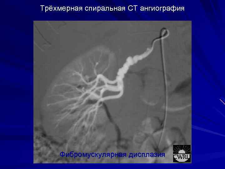 Трёхмерная спиральная CT ангиография Фибромускулярная дисплазия 