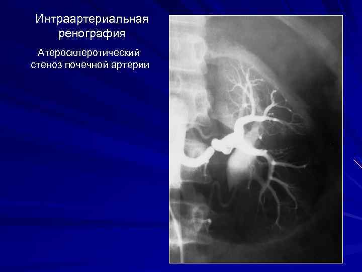 Аберрантная почечная артерия