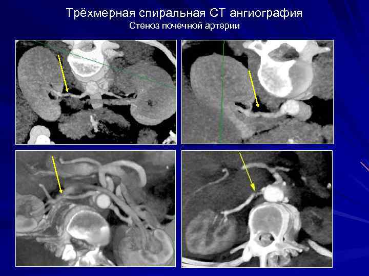 Трёхмерная спиральная CT ангиография Стеноз почечной артерии 