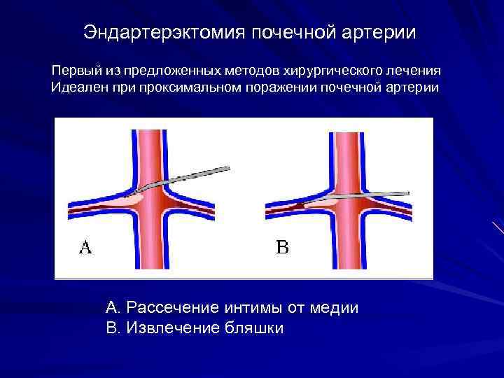 Эндартерэктомия почечной артерии Первый из предложенных методов хирургического лечения Идеален при проксимальном поражении почечной