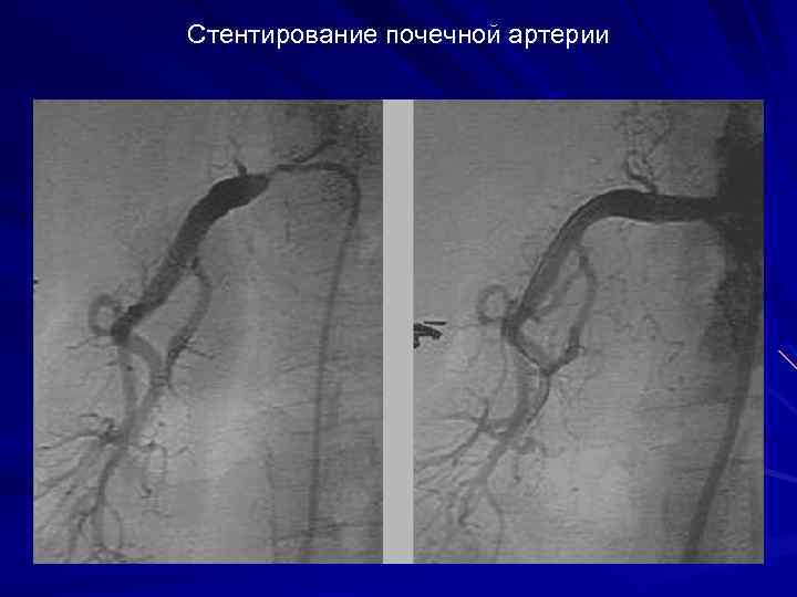 Стентирование почечной артерии 
