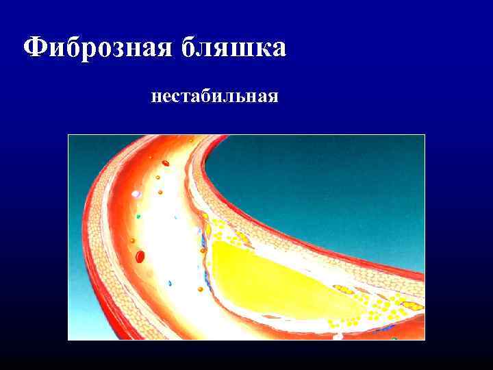 Фиброзная бляшка нестабильная 