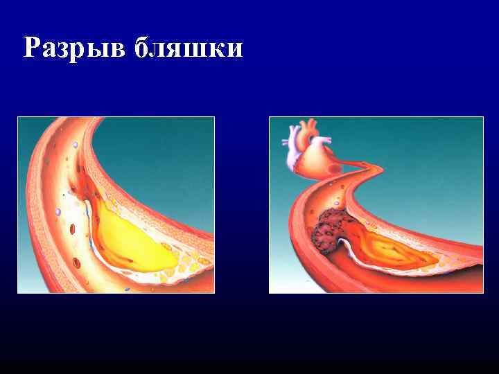 Разрыв бляшки 