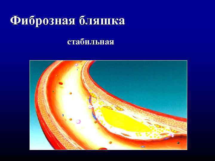 Фиброзная бляшка стабильная 