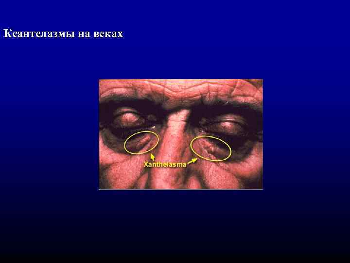 Ксантелазмы на веках 