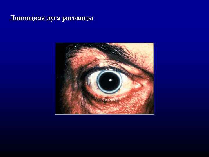 Липоидная дуга роговицы 