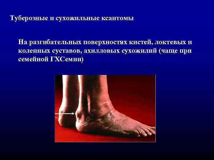 Туберозные и сухожильные ксантомы На разгибательных поверхностях кистей, локтевых и коленных суставов, ахилловых сухожилий