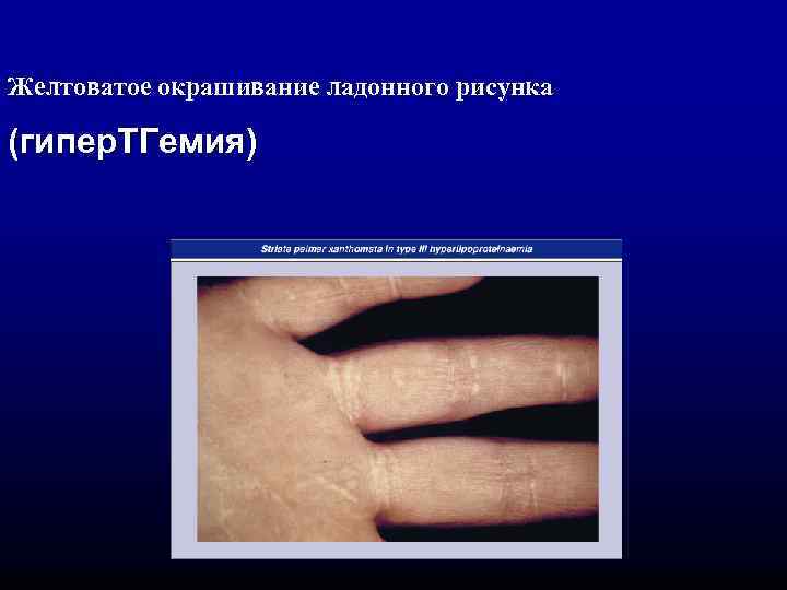Желтоватое окрашивание ладонного рисунка (гипер. ТГемия) 