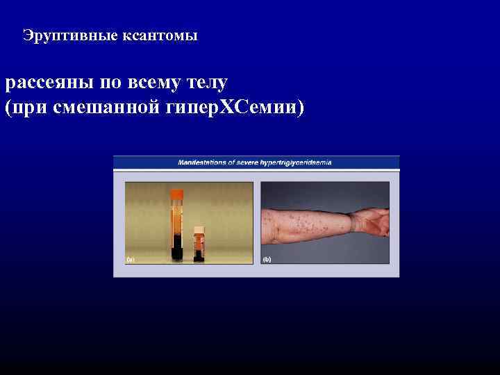 Эруптивные ксантомы рассеяны по всему телу (при смешанной гипер. ХСемии) 