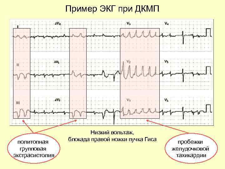 Экг при дилатационной кардиомиопатии фото