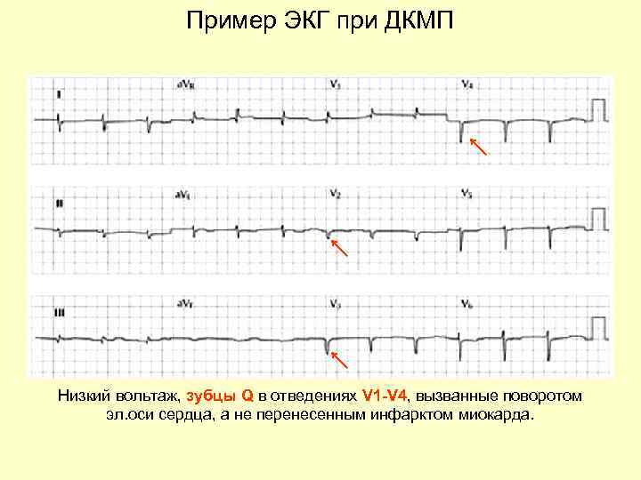 Вольтаж экг