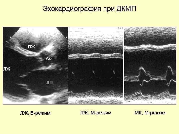 Эхокардиография при ДКМП ЛЖ, В-режим ЛЖ, М-режим МК, М-режим 