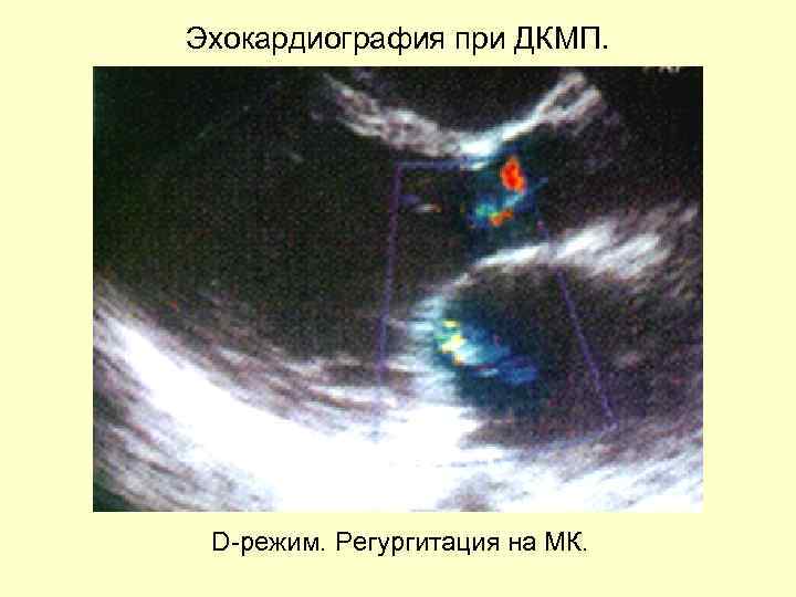 Эхокардиография при ДКМП. D-режим. Регургитация на МК. 