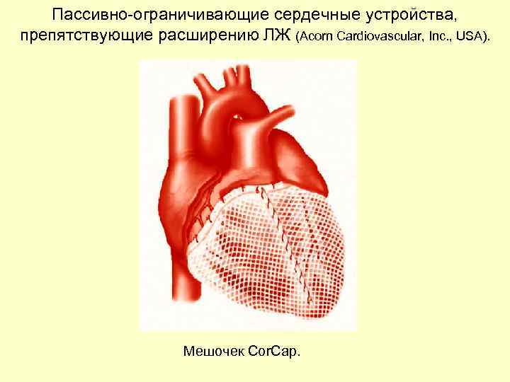 Пассивно-ограничивающие сердечные устройства, препятствующие расширению ЛЖ (Acorn Cardiovascular, Inc. , USA). Мешочек Cor. Cap.