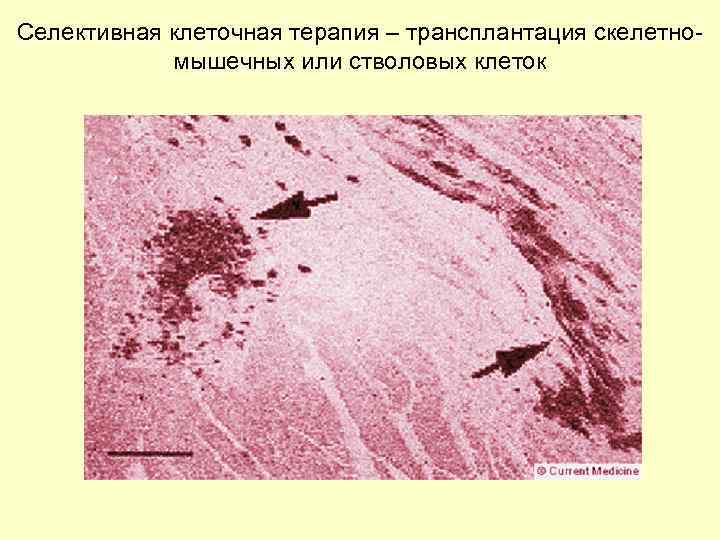 Селективная клеточная терапия – трансплантация скелетномышечных или стволовых клеток 