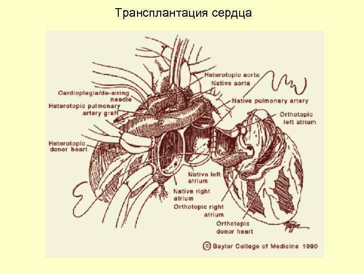 Трансплантация сердца 