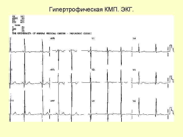 Гипертрофическая КМП. ЭКГ. 