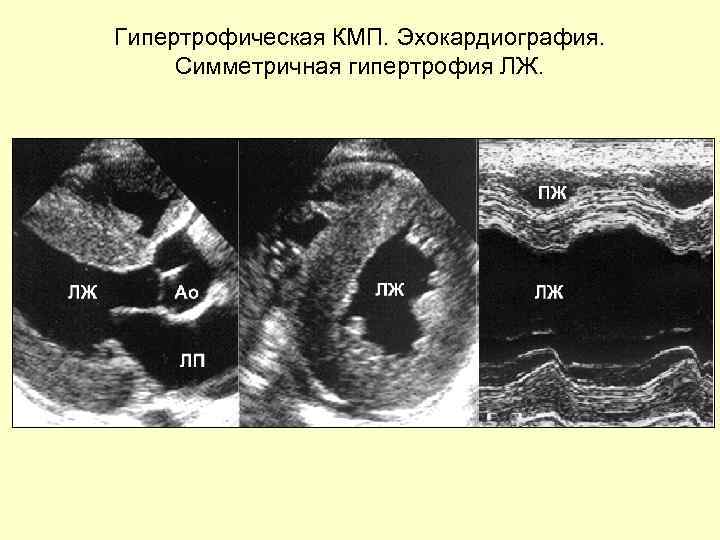 Гипертрофическая КМП. Эхокардиография. Симметричная гипертрофия ЛЖ. 