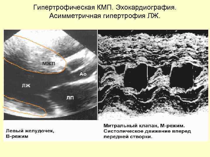 Гипертрофическая КМП. Эхокардиография. Асимметричная гипертрофия ЛЖ. 