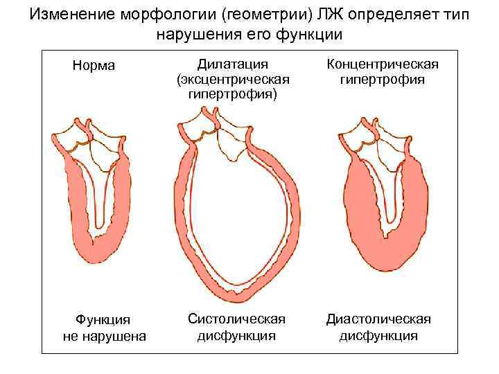 Дилатация камер сердца. Типы гипертрофии левого желудочка. Концентрическая гипертрофия миокарда. Концентрическая гипертрофия левого желудочка. Концентрическая гипертрофия миокарда левого желудочка.