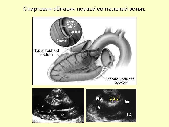 Спиртовая аблация первой септальной ветви. 