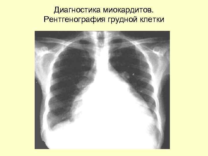 Диагностика миокардитов. Рентгенография грудной клетки 