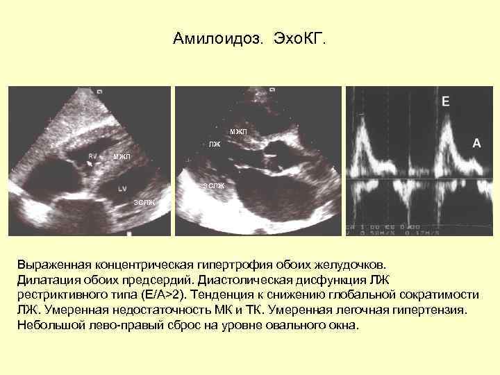 Базальная гипертрофия мжп