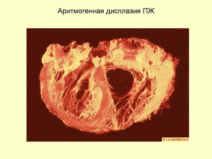 Аритмогенная дисплазия правого