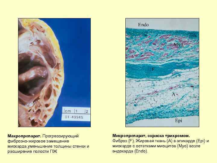 Макропрепарат. Прогрессирующий фиброзно-жировое замещение миокарда, уменьшение толщины стенки и расширение полости ПЖ Микропрепарат, окраска