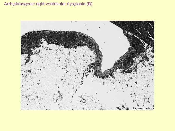 Arrhythmogenic right ventricular dysplasia (B) 