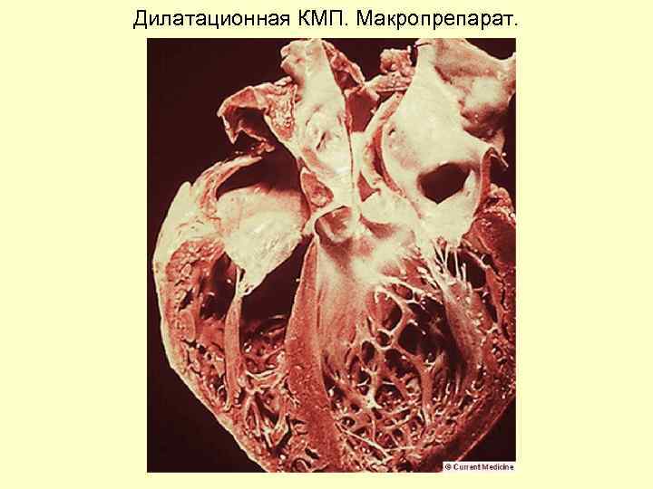 Дилатационная КМП. Макропрепарат. 