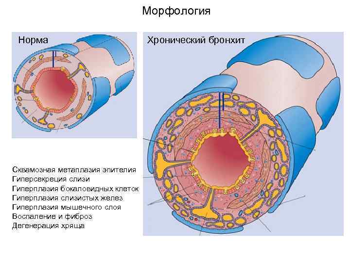 Морфология Норма Сквамозная метаплазия эпителия Гиперсекреция слизи Гиперплазия бокаловидных клеток Гиперплазия слизистых желез Гиперплазия