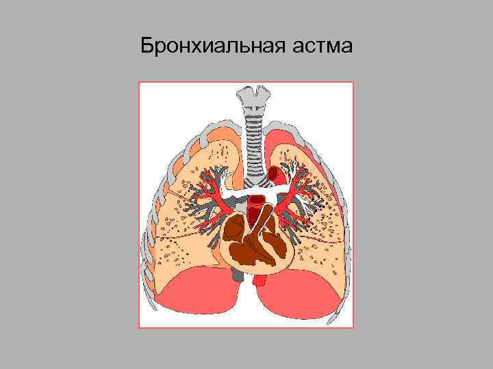 Бронхиальная астма 