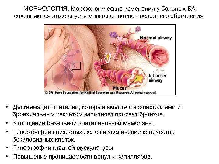 МОРФОЛОГИЯ. Морфологические изменения у больных БА сохраняются даже спустя много лет последнего обострения. •