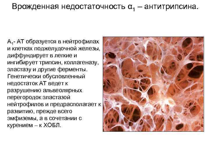 Дефицит альфа 1 антитрипсина у детей презентация