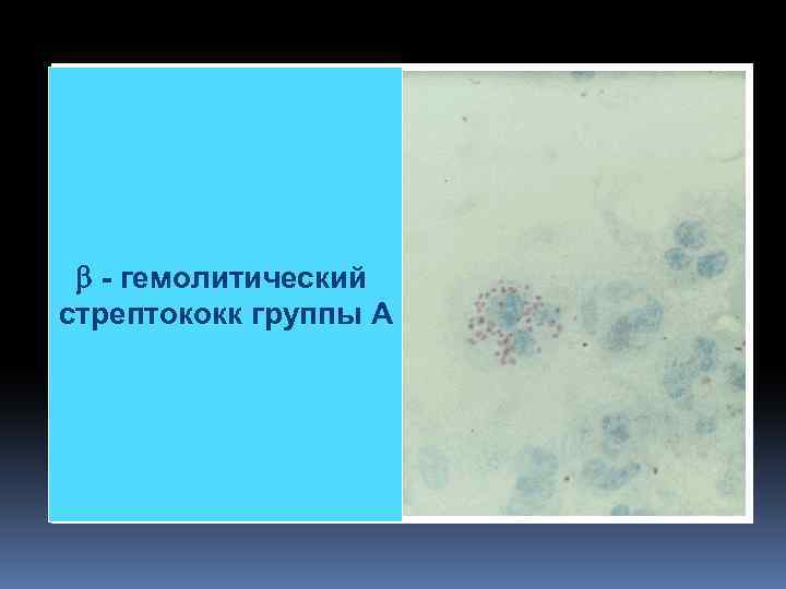  - гемолитический стрептококк группы А 