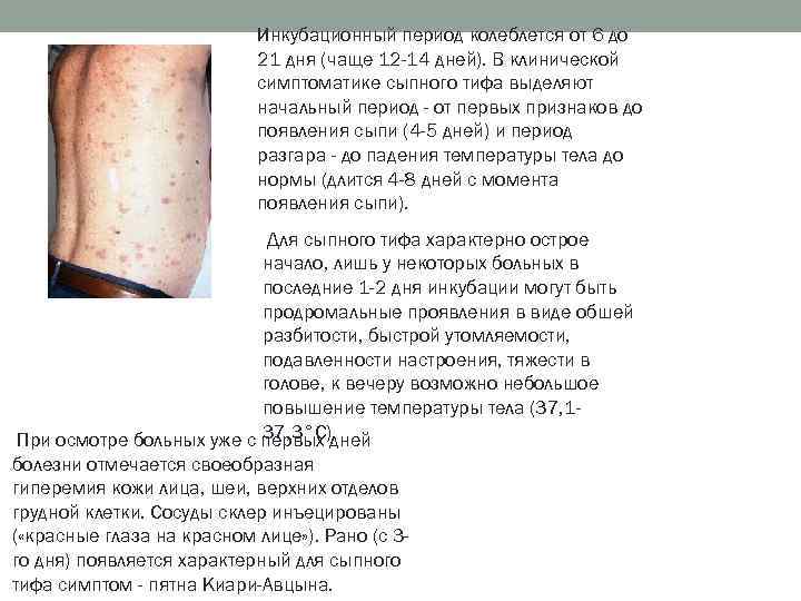 Инкубационный период колеблется от 6 до 21 дня (чаще 12 -14 дней). В клинической