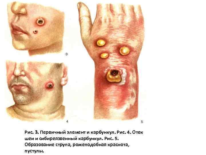 Рис. 3. Первичный элемент и карбункул. Рис. 4. Отек шеи и сибиреязвенный карбункул. Рис.