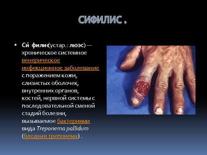 СИФИЛИС. Си филис(устар. : люэс) — хроническое системное венерическое инфекционное заболевание с поражением кожи,