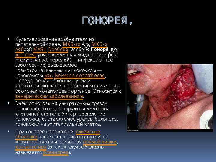 ГОНОРЕЯ. Культивирование возбудителя на питательной среде. МКБ-10 A 54 МКБ-9 098098 Me. SH D