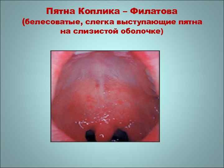 Пятна Коплика – Филатова (белесоватые, слегка выступающие пятна на слизистой оболочке) 