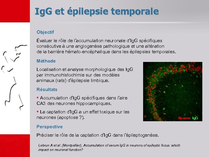 Ig. G et épilepsie temporale Objectif Évaluer le rôle de l’accumulation neuronale d’Ig. G
